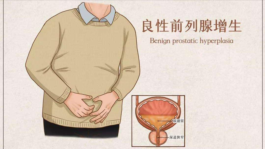 排尿费劲,滴滴答答怎么办?医生为您专业解答