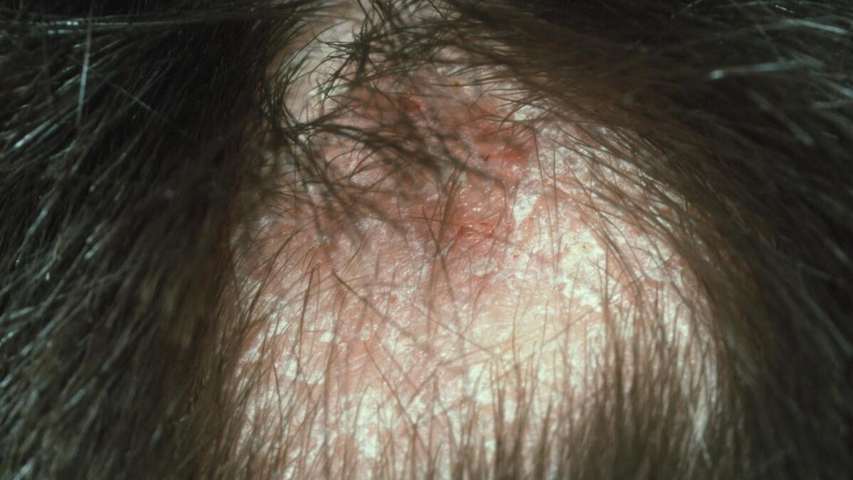 头皮屑太多是不是血虚,头皮屑多是因为有炎症么