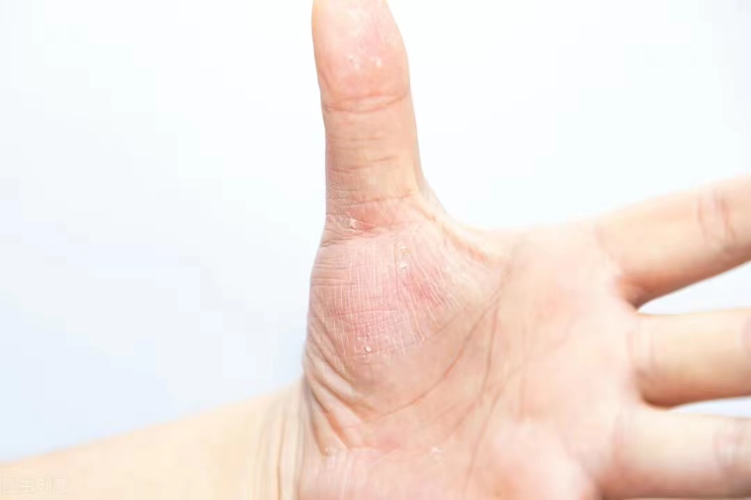 湿疹汗疱疹与水疱型手癣区别,汗疱疹湿疹的根治方法