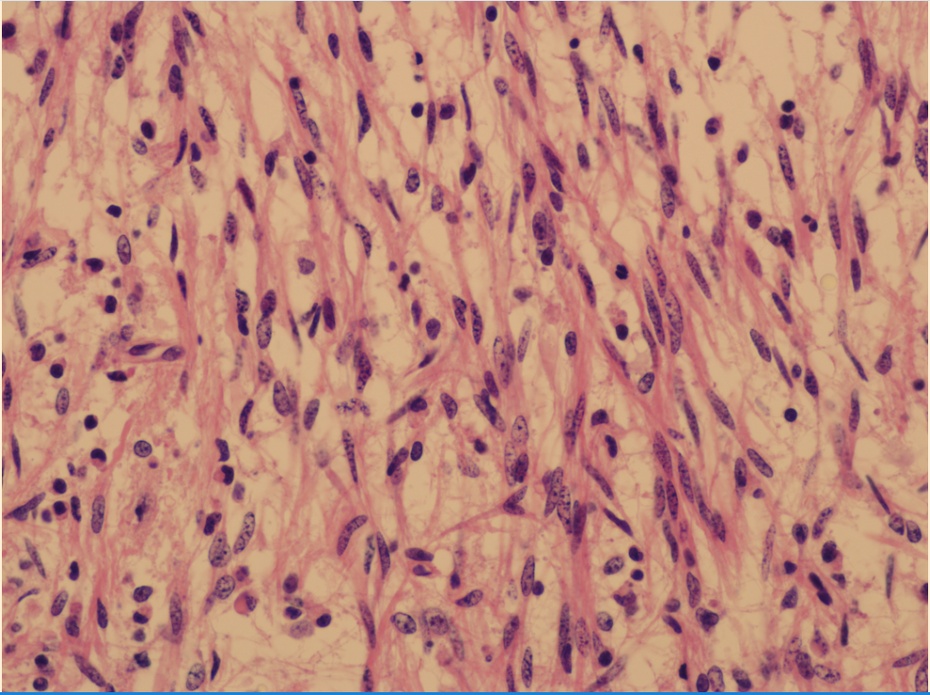 贺晓生教授胶质瘤的手术治疗实例,贺晓生神经外科教授视频