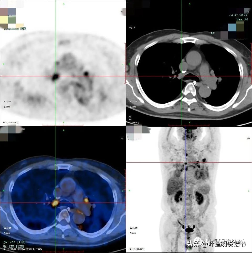 pet判断淋巴结转移,petct判断癌有没有转移准确吗