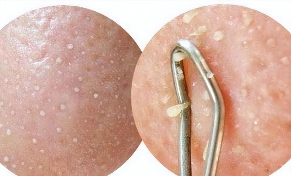 鼻子黑头里挤出的白色油脂怎么办,鼻子上有硬硬的黑头怎么办