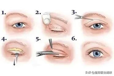 埋线双眼皮眼部淤青很厉害怎么办,埋线双眼皮没有那么明显了怎么办