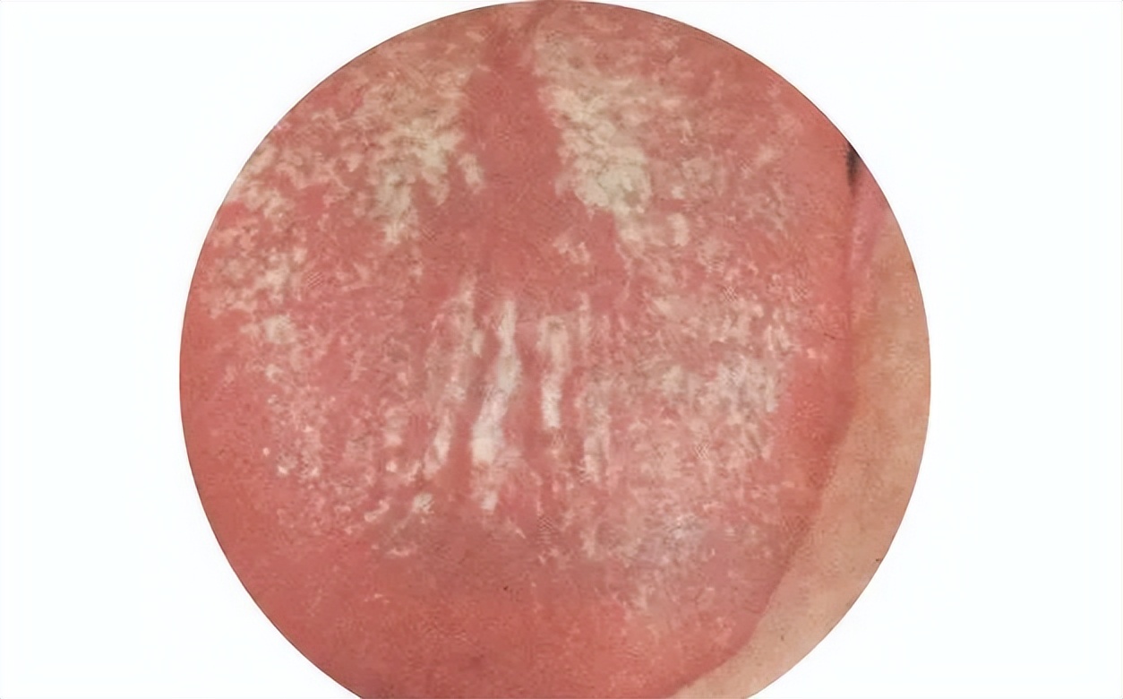 中医看舌苔｜这是不是你家小孩的舌苔？