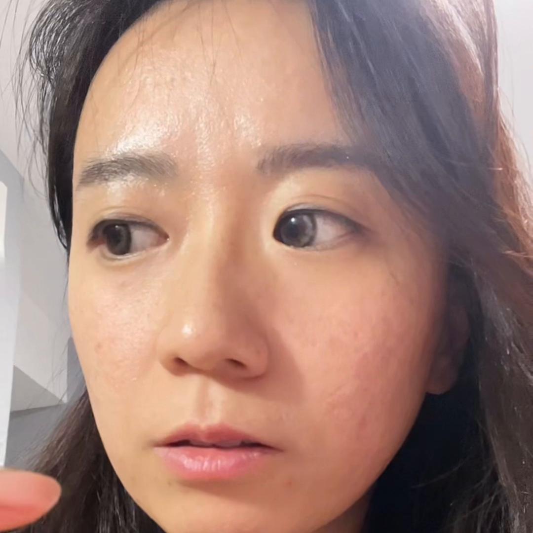 姐妹治好痘痘的视频,姐妹们广州治疗痘痘