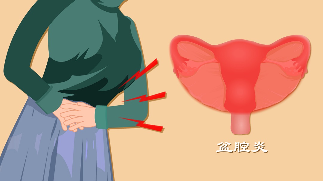 盆腔炎需清热，热敷加足浴，专攻盆腔炎