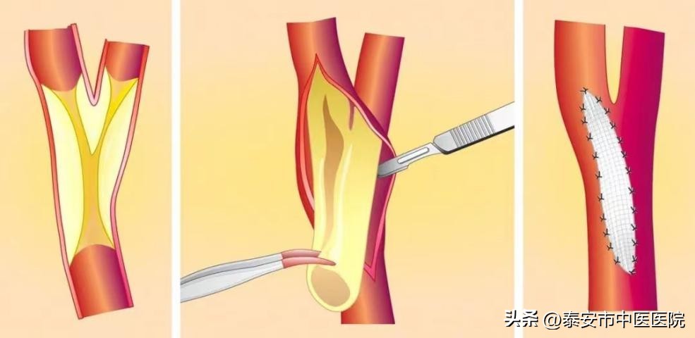 *安泰**市中医医院脑病外科成功开展一例高难度“颈动脉内膜剥脱术”