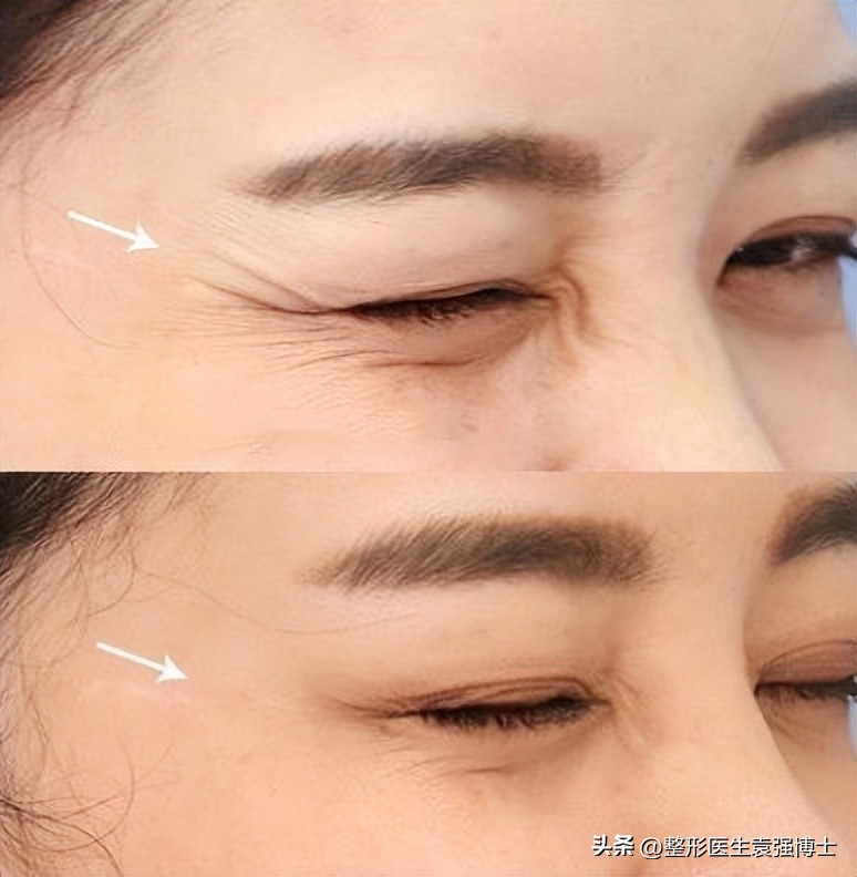 抗衰医美步骤有哪些项目,抗衰的医美项目有哪些