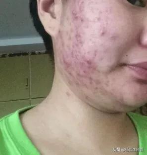 青春痘是怎么形成的怎么去除,青春痘是什么引起的怎样根治