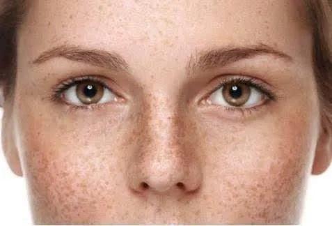 色斑形成的几个阶段和解决方法,色斑的形成原因及解决方法