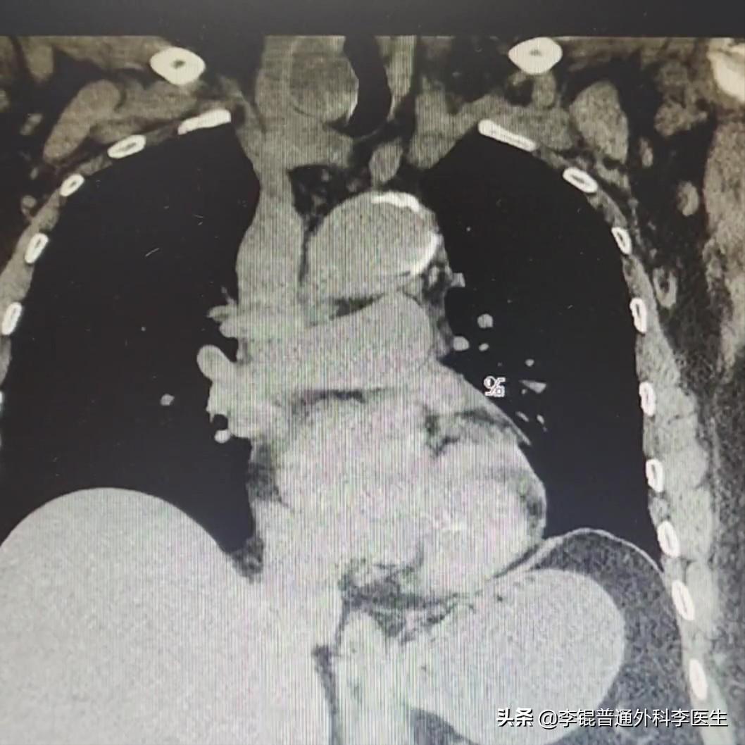 老人肺炎一整个肺都不好使怎么办,老人肺炎反反复复能治好吗