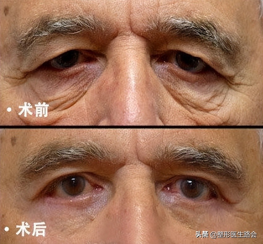 北京眼袋泪沟手术,老人泪沟眼袋