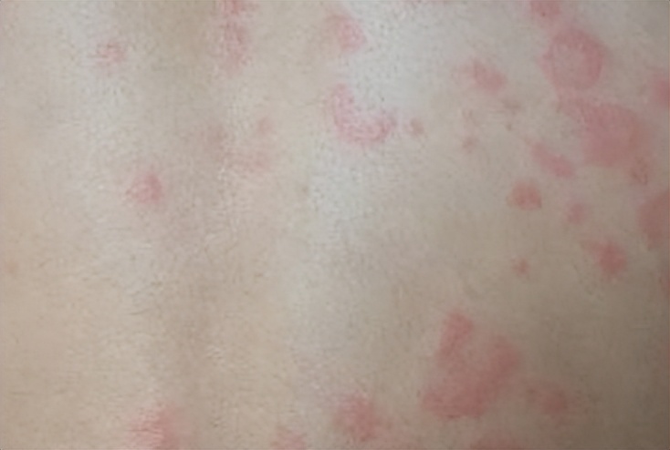 皮肤上有好多小红点是什么情况,皮肤上经常出现小红点是怎么治