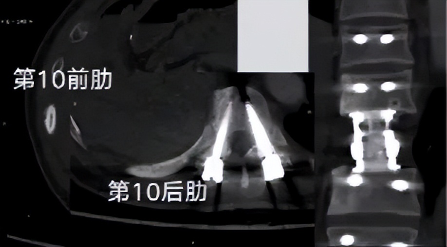 多原发癌症转移,多原发直肠癌