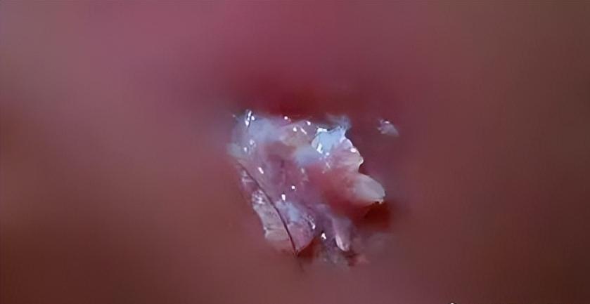 尖锐性湿疣感染后几天疣体能出来,尖锐性湿疣会长在前胸后背吗