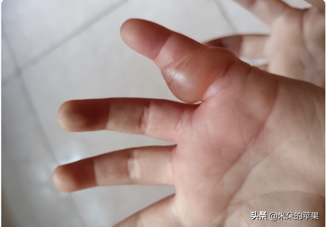 孩子被蚊子咬了很痒怎么办,孩子被蚊子咬痒得厉害怎么办