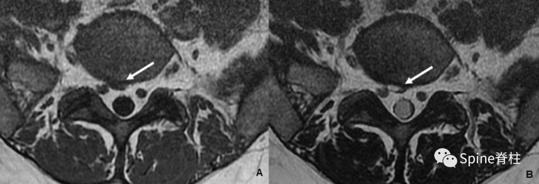 腰椎椎管有囊性结构,水平椎管内囊性占位