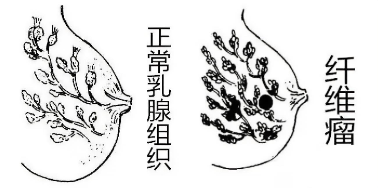 乳腺彩超实质性占位病变什么意思,乳腺检查有团块是啥意思