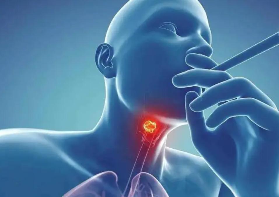 喉癌致病的原因,喉癌的高发人群主要有哪些