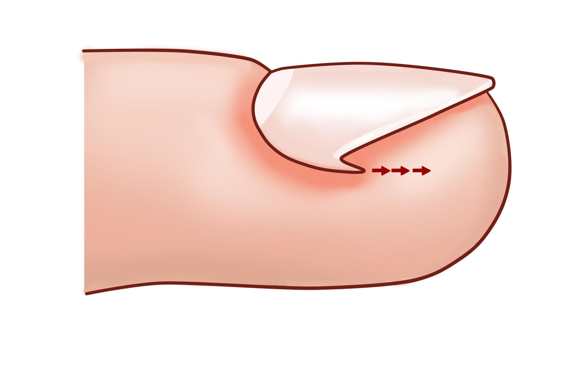 得了甲沟炎一定要拔指甲就能好吗,甲沟炎指甲陷肉里拔不出来怎么办