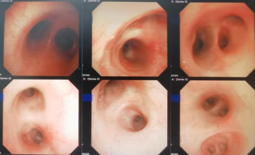 婴儿间断性咳嗽是怎么回事,儿童咳嗽肺部有微小结节有事吗