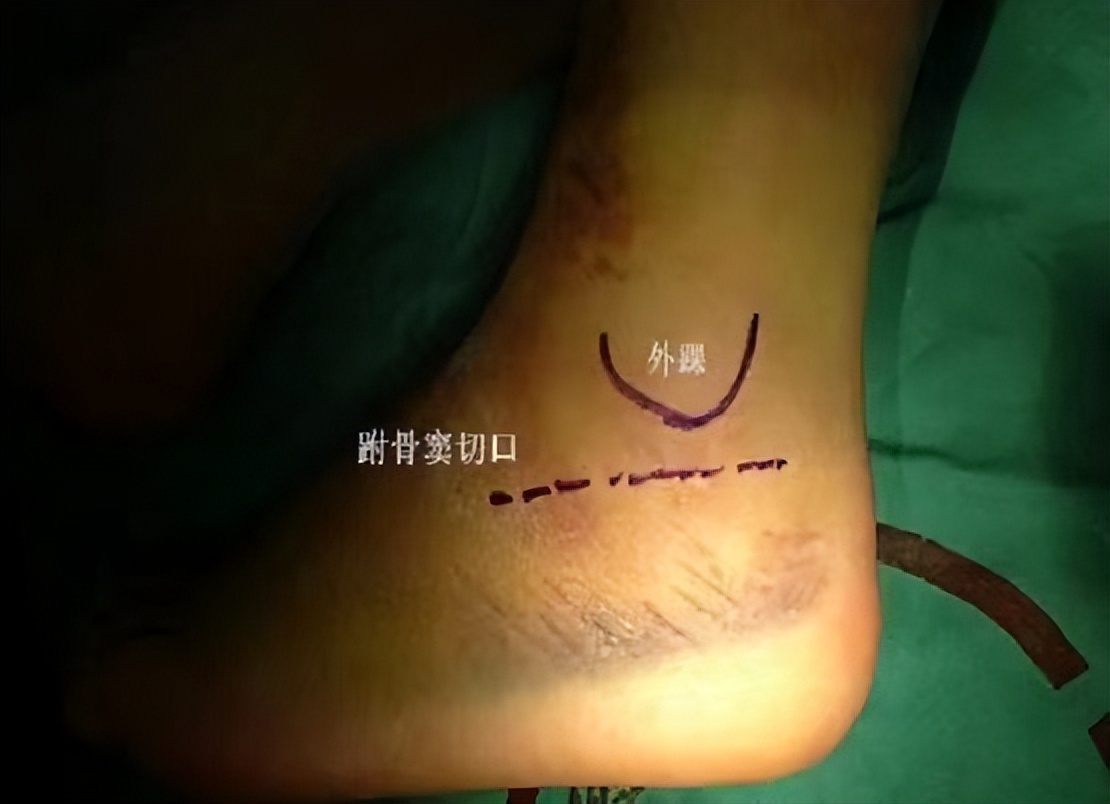 跗骨窦手术能治好吗,跗骨窦入路治疗跟骨骨折适应症