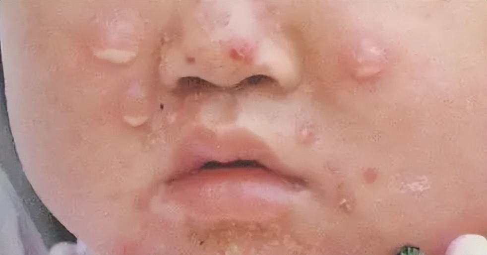 真菌清热除湿的口服中成药,细菌性皮肤病的常用药