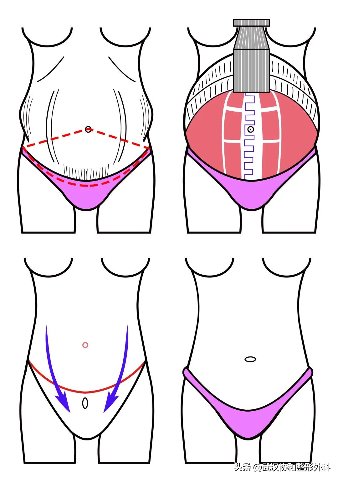 腹壁整形需要咨询问题,腹壁整形术亲身经历分享