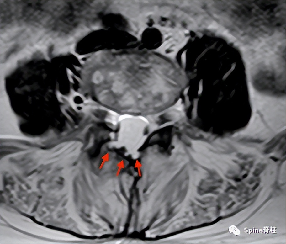 硬膜扩张,duralectasia