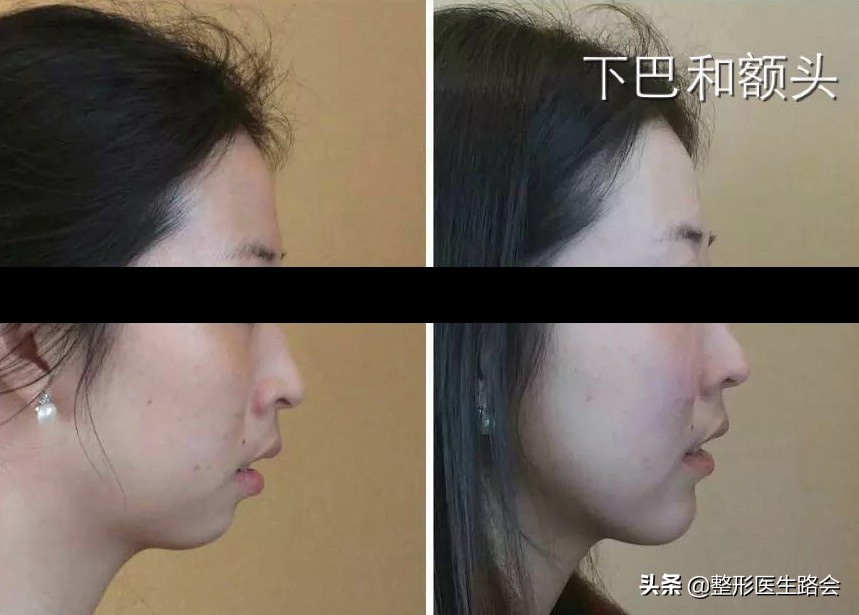 填充额头出现凹坑过于饱满,额头填充怎么避免踩坑