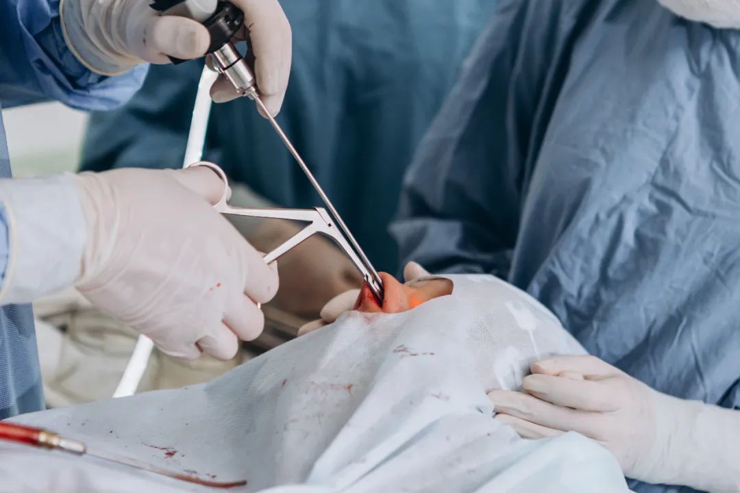 鼻窦炎手术切除了一块骨头,鼻窦炎手术后患者