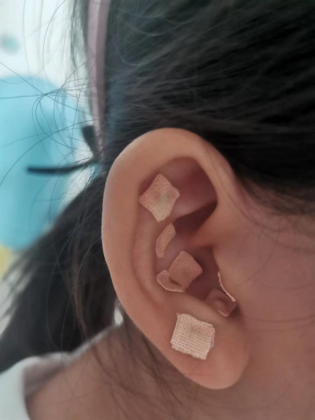 儿童抽动症的经络疗法,小儿抽动症耳针疗法