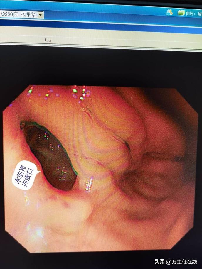 腹腔粘液癌治疗有妙招——万荣教授以内镜Notes技术成功胃减压