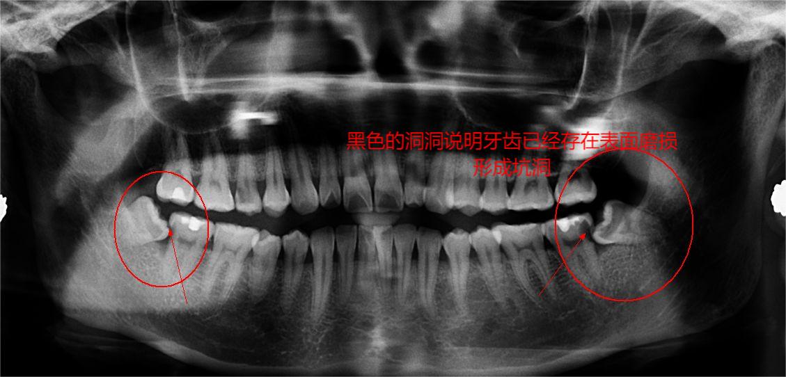 左下智齿拔除视频怎么正确拔除,复杂智齿拔除操作详细流程
