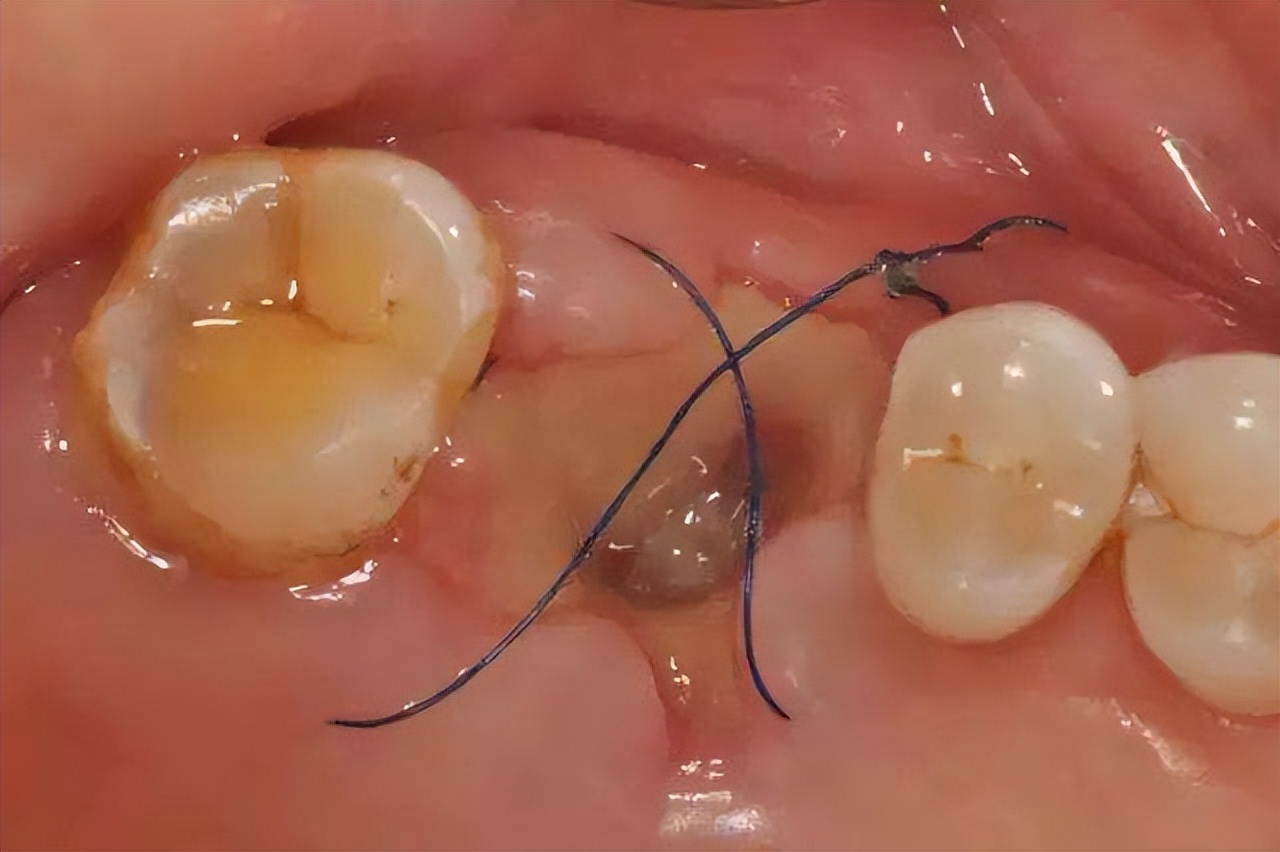 拔牙如何避免干槽症,拔牙后怎么避免干槽症