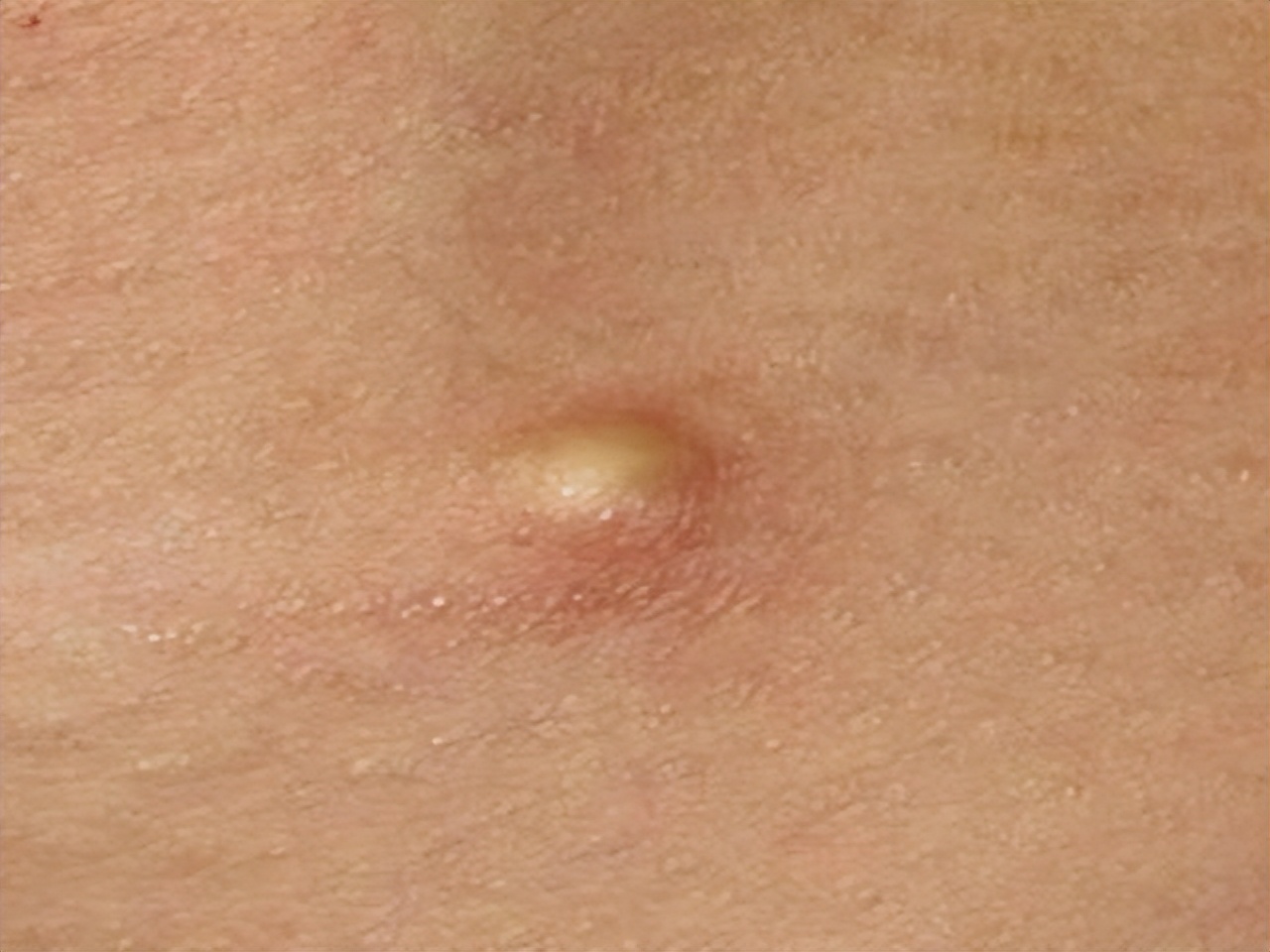 脖子腋下长小肉粒可以用手揪掉吗,脖子旁边出现小肉粒能直接揪掉吗