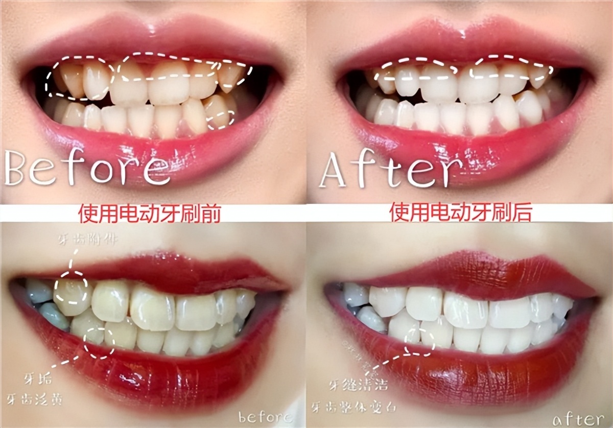 u型电动牙刷的弊端,电动牙刷的危害弊端