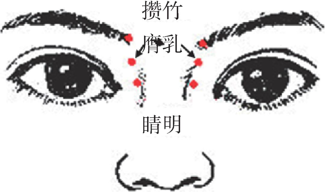 针灸治疗斑秃、乳房胀痛、斑秃、甲状腺结节、贝尔麻痹