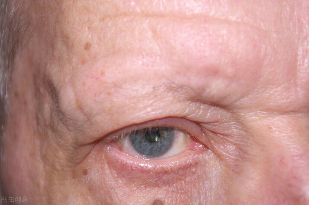 结膜炎最快的消除方法,结膜炎是什么原因引起的儿童