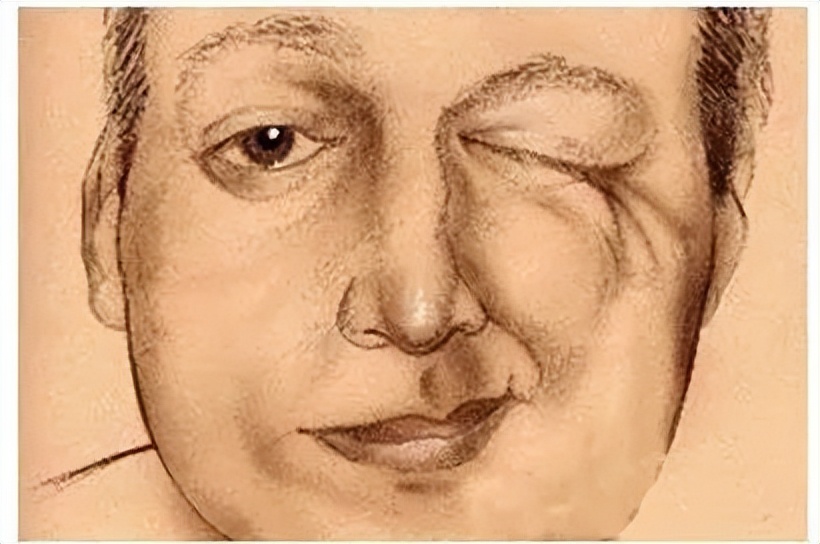 面肌痉挛下眼皮跳为什么会有凹陷,眼皮跳一个月就能确诊面肌痉挛吗