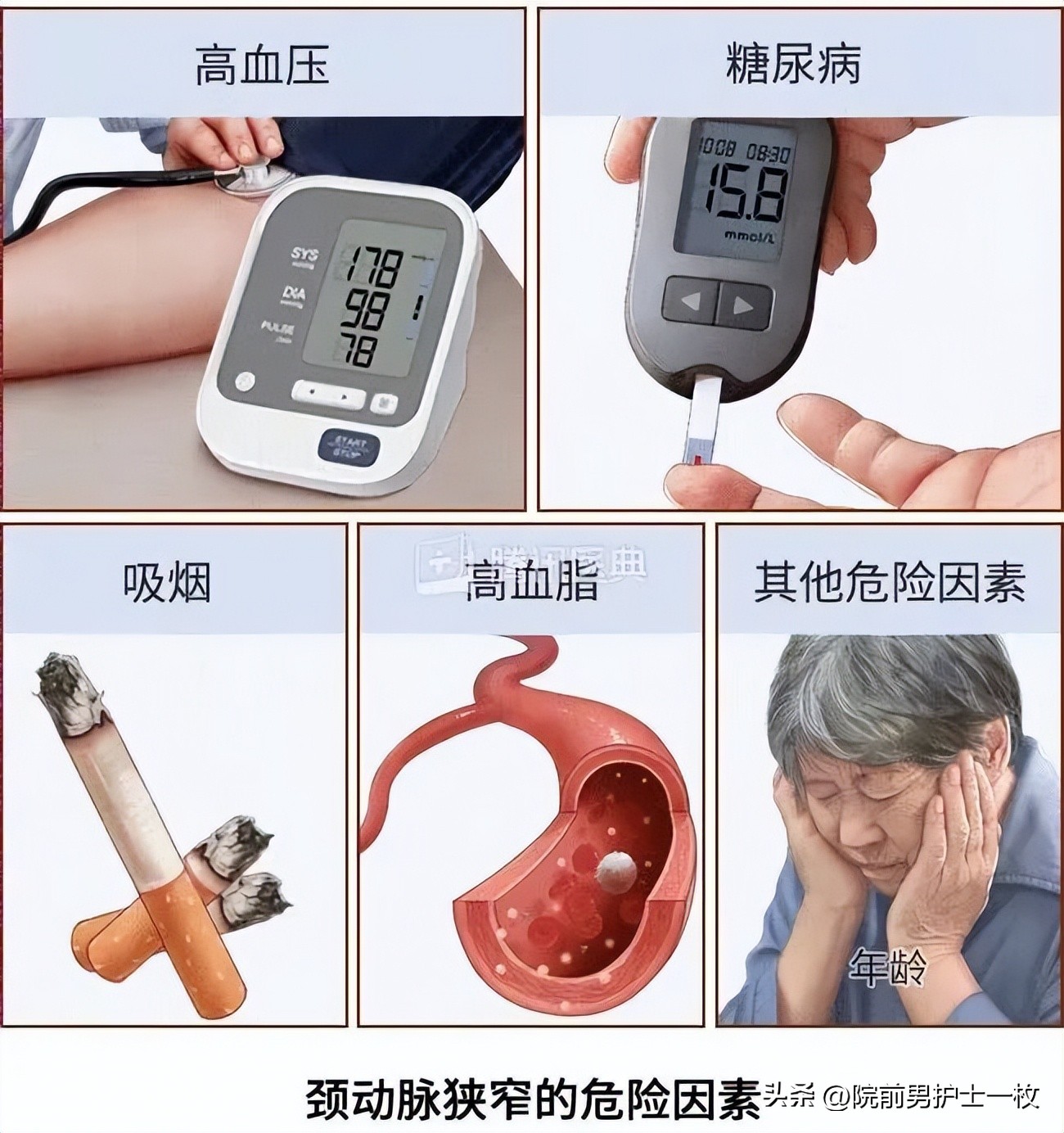 颈动脉斑块的相关知识,颈动脉斑块应该注意哪些事项