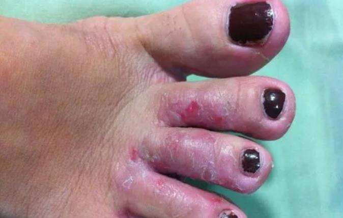 日本人如何处理脚气问题,欧美人为什么更容易患脚气