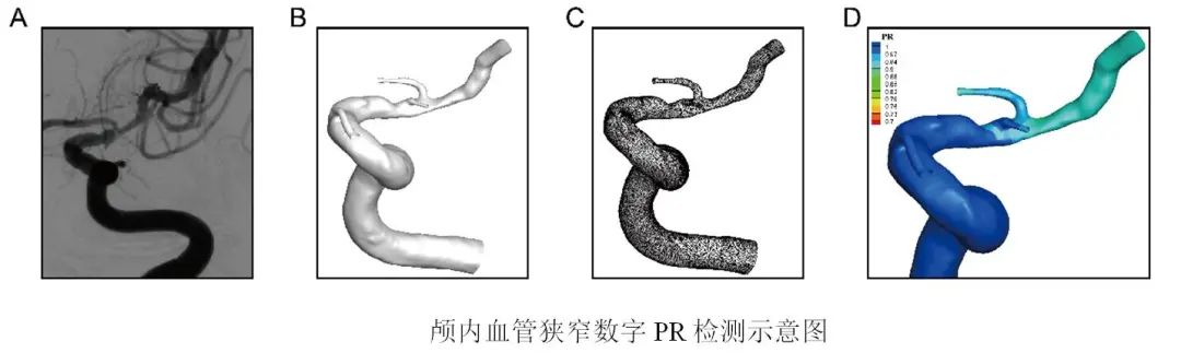 首创国内ICAS多模态评估体系开创脑血管领域精准诊疗新纪元