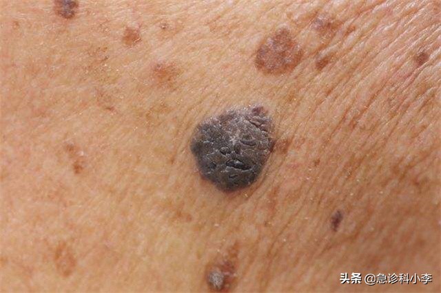 身上出现不痒的小红点是怎么回事,身上突然起了很多小红点不痛不痒