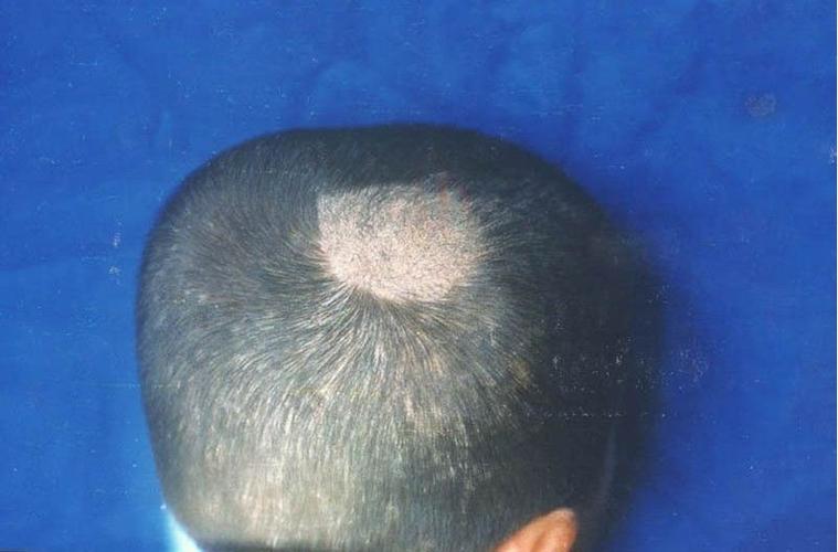 皮肤癣摸一下会传染么,顽固皮肤癣会传染吗