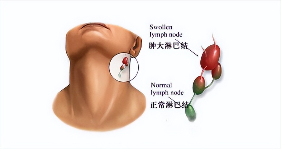 大腿根淋巴结肿大,淋巴结为何会肿大