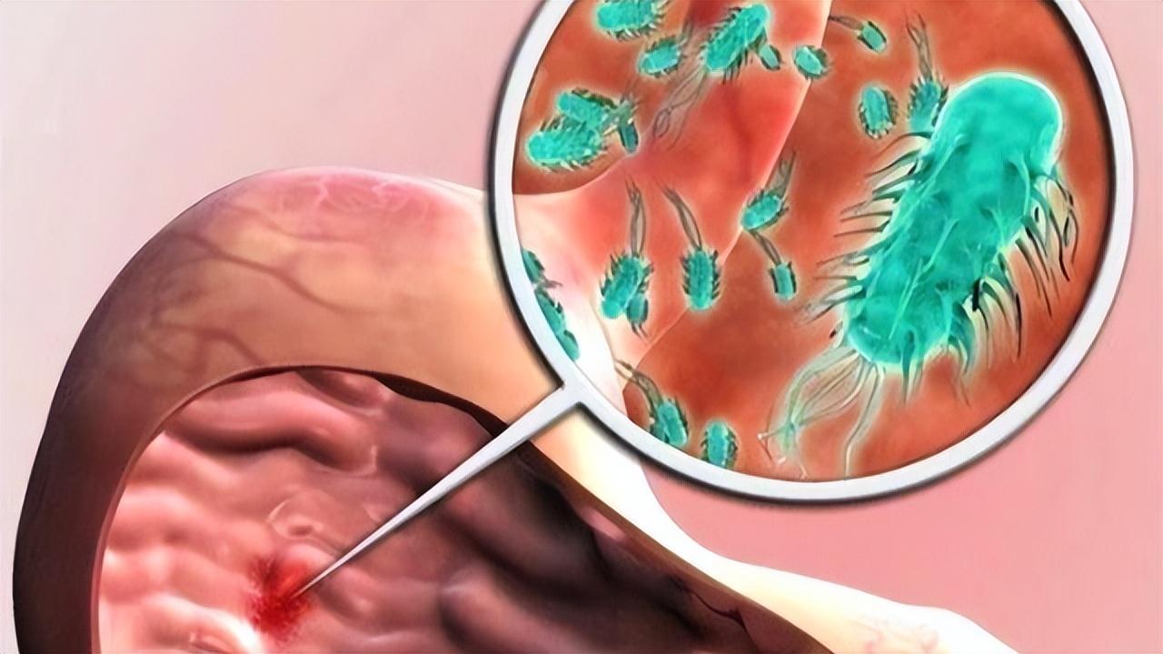 幽门螺杆菌感染阳性可以治好吗,幽门螺杆菌阳性是不是很严重