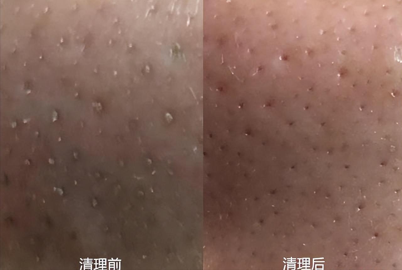 鼻子上有白白的小点可以挤吗,鼻子上黑黑的小点点怎么去除