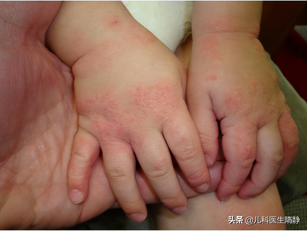 小米粒大小的疙瘩是怎么回事,起密密麻麻的小疙瘩咋回事