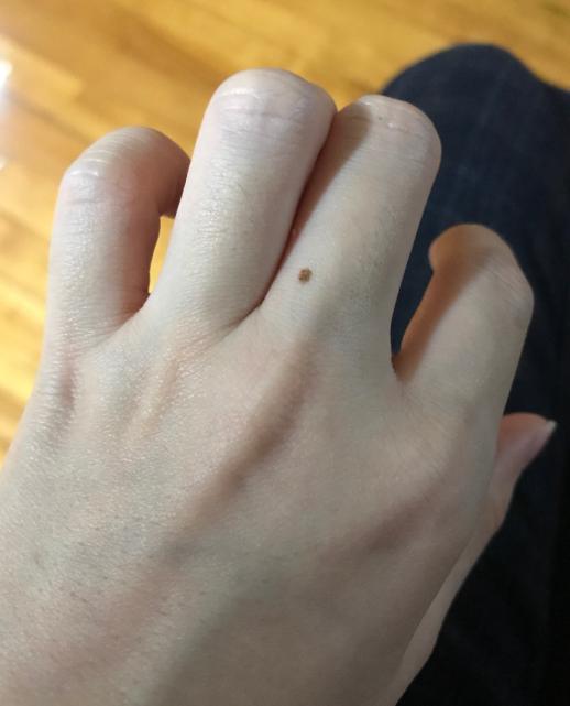 长在身体什么部位的痣容易癌变,脖子突然长痣是癌症的症状